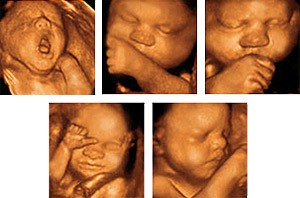 UltraSonografia